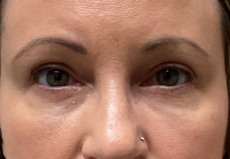 BLEPHAROPLASTY Before & After Gallery - Patient 379676 - Image 2
