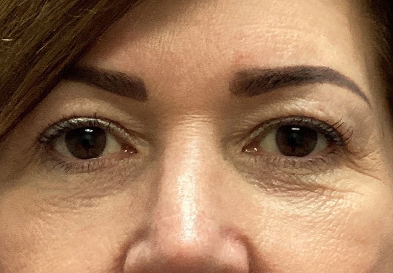BLEPHAROPLASTY Before & After Gallery - Patient 419971 - Image 1