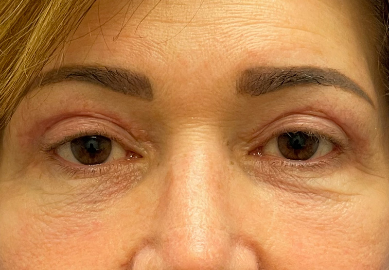 BLEPHAROPLASTY Before & After Gallery - Patient 419971 - Image 2