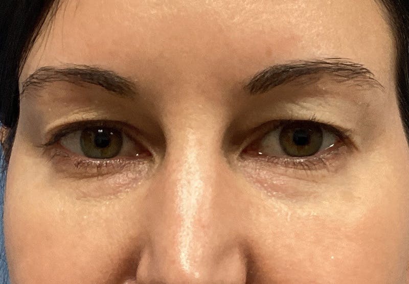 Before and after blepharoplasty