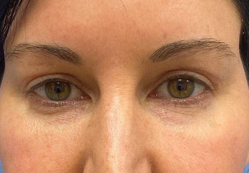 Before and after blepharoplasty