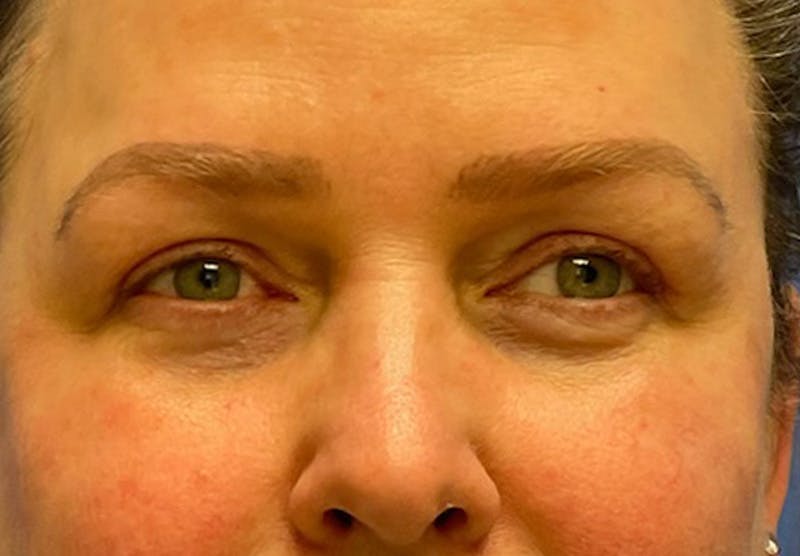 Before and after blepharoplasty
