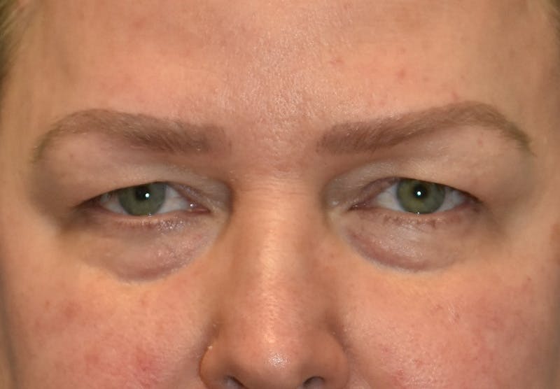 Before and after blepharoplasty