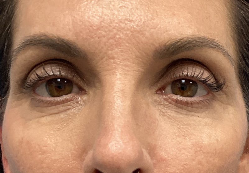 Before and after blepharoplasty