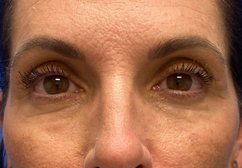 Before and after blepharoplasty