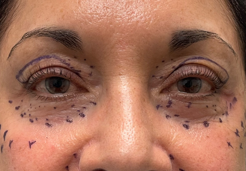 BLEPHAROPLASTY Before & After Gallery - Patient 294435 - Image 1