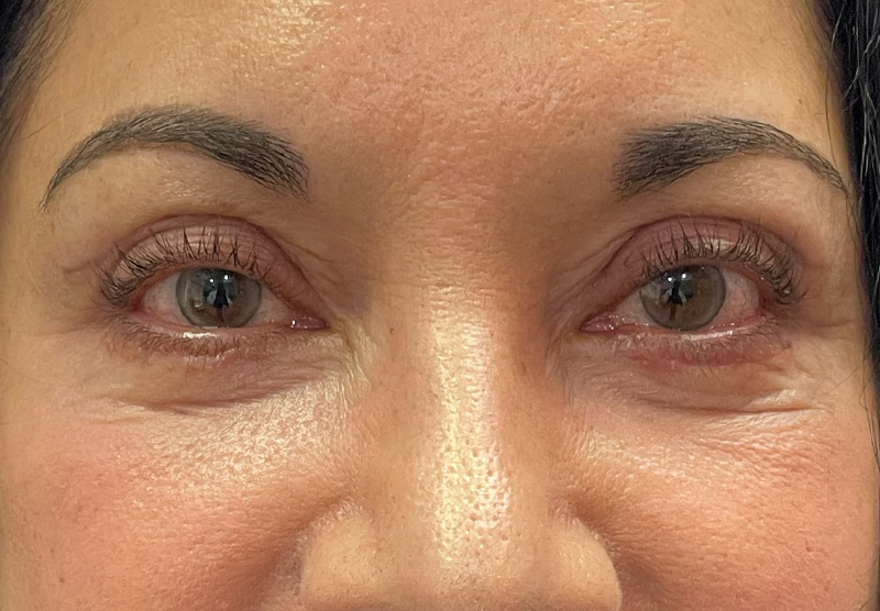 BLEPHAROPLASTY Before & After Gallery - Patient 294435 - Image 2