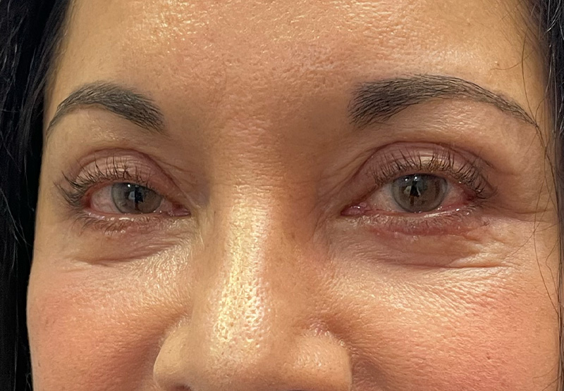 BLEPHAROPLASTY Before & After Gallery - Patient 294435 - Image 8