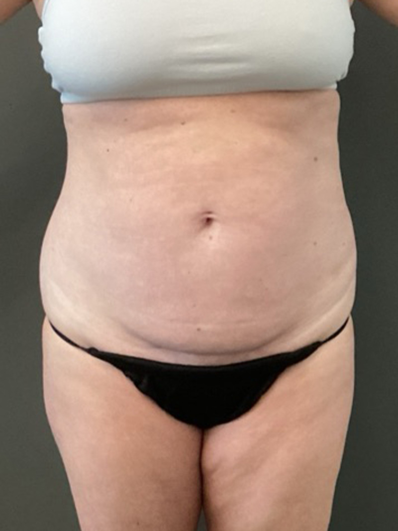 TUMMY TUCK Before & After Gallery - Patient 112744 - Image 1