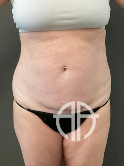 TUMMY TUCK Before & After Gallery - Patient 112744 - Image 1