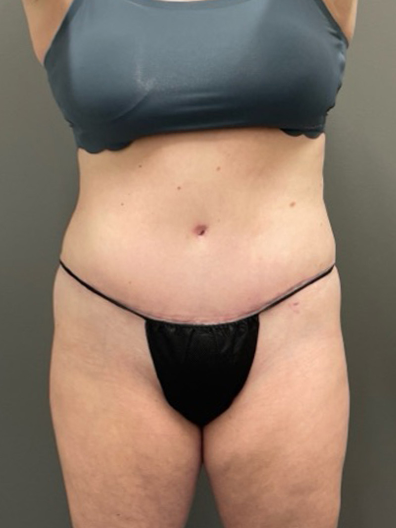 TUMMY TUCK Before & After Gallery - Patient 112744 - Image 2