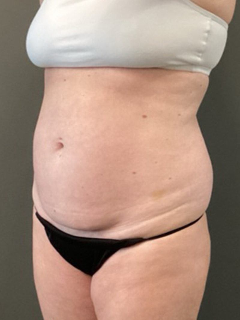 TUMMY TUCK Before & After Gallery - Patient 112744 - Image 3