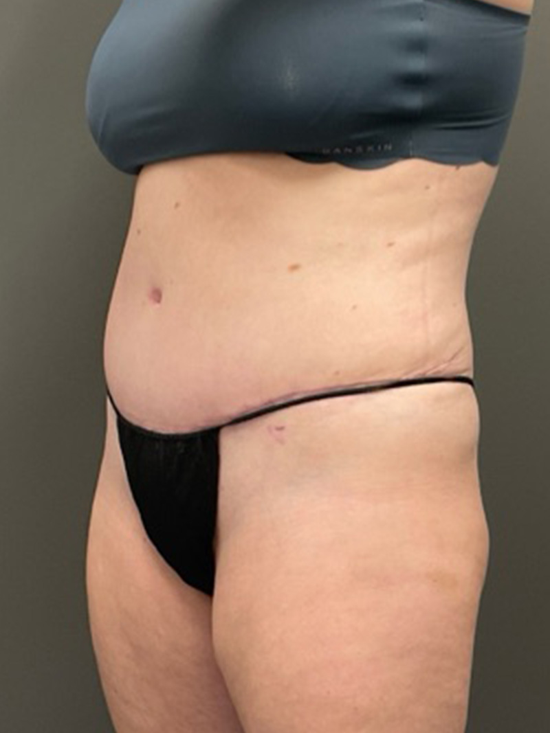TUMMY TUCK Before & After Gallery - Patient 112744 - Image 4