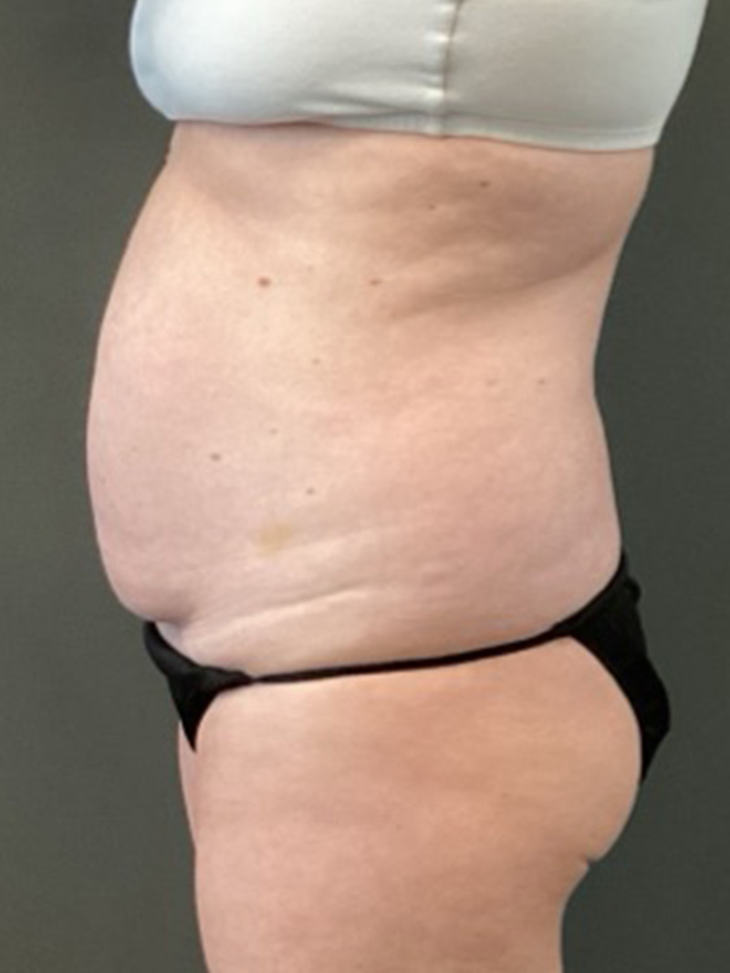 TUMMY TUCK Before & After Gallery - Patient 112744 - Image 5