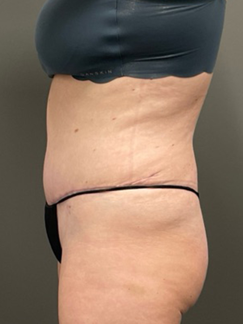 TUMMY TUCK Before & After Gallery - Patient 112744 - Image 6