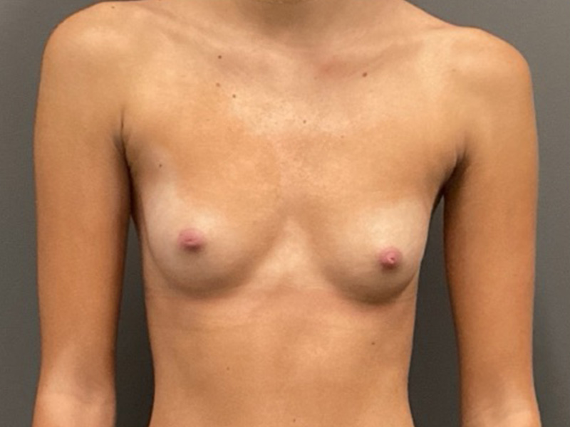 BREAST AUGMENTATION Before & After Gallery - Patient 326307 - Image 1