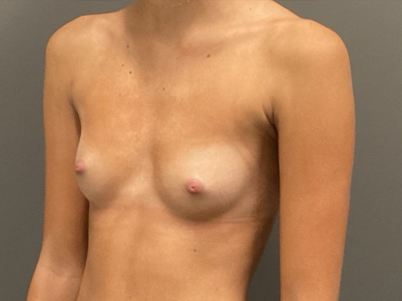 BREAST AUGMENTATION Before & After Gallery - Patient 326307 - Image 3