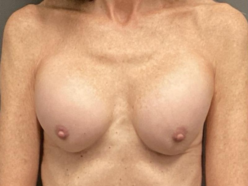 BREAST IMPLANT EXCHANGE Before & After Gallery - Patient 375496 - Image 1