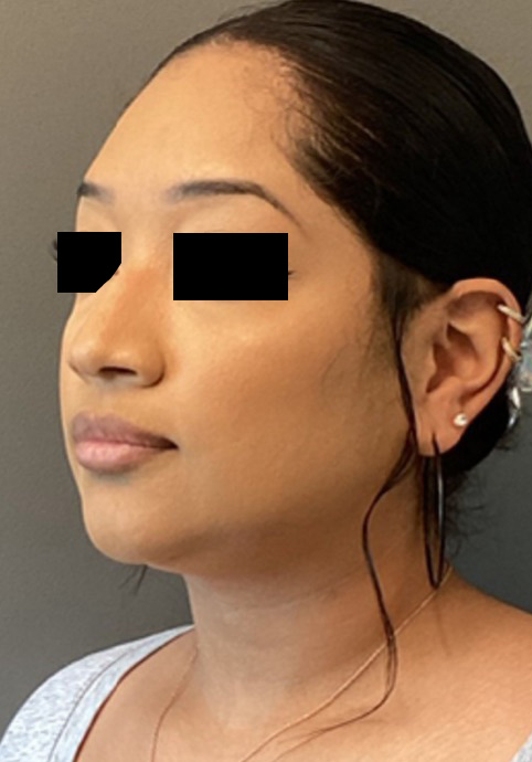 LIQUID RHINOPLASTY Before & After Gallery - Patient 191330 - Image 3