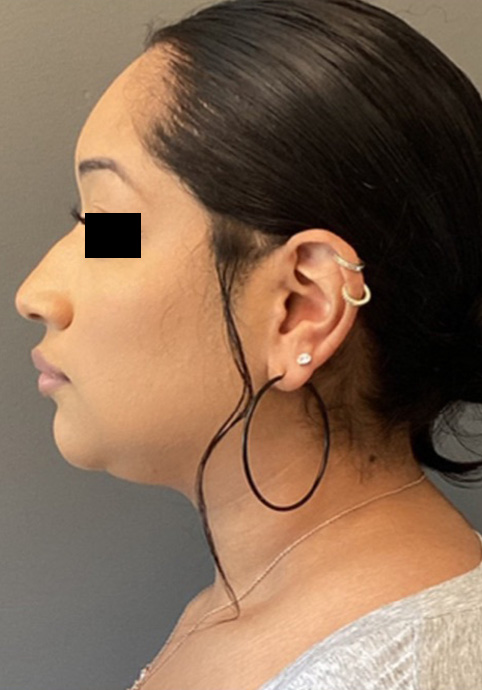 LIQUID RHINOPLASTY Before & After Gallery - Patient 191330 - Image 5