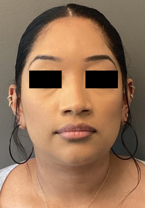 LIQUID RHINOPLASTY Before & After Gallery - Patient 191330 - Image 1