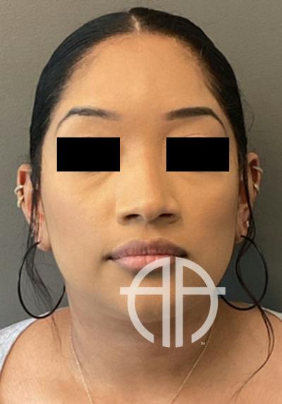 LIQUID RHINOPLASTY Before & After Gallery - Patient 191330 - Image 1