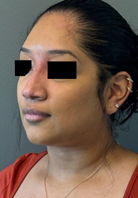 LIQUID RHINOPLASTY Before & After Gallery - Patient 191330 - Image 4
