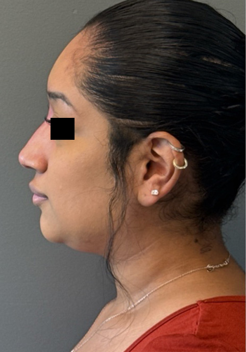 LIQUID RHINOPLASTY Before & After Gallery - Patient 191330 - Image 6