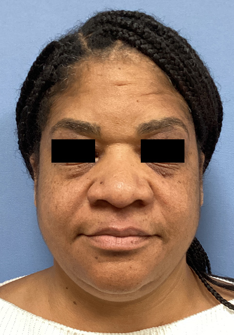 LIQUID RHINOPLASTY Before & After Gallery - Patient 427100 - Image 1