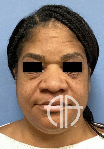 LIQUID RHINOPLASTY Before & After Gallery - Patient 427100 - Image 1