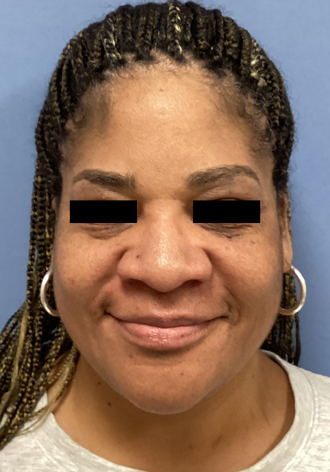 LIQUID RHINOPLASTY Before & After Gallery - Patient 427100 - Image 2