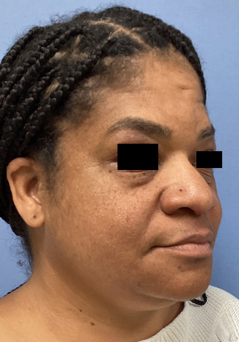 LIQUID RHINOPLASTY Before & After Gallery - Patient 427100 - Image 3