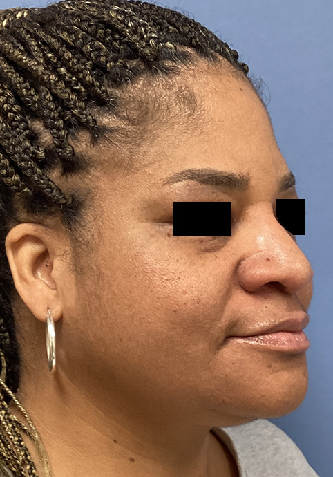 LIQUID RHINOPLASTY Before & After Gallery - Patient 427100 - Image 4