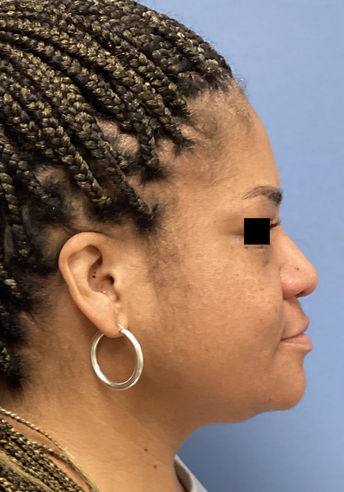 LIQUID RHINOPLASTY Before & After Gallery - Patient 427100 - Image 6