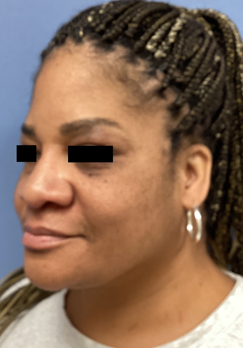 LIQUID RHINOPLASTY Before & After Gallery - Patient 427100 - Image 8
