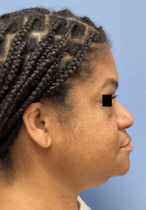 LIQUID RHINOPLASTY Before & After Gallery - Patient 427100 - Image 5