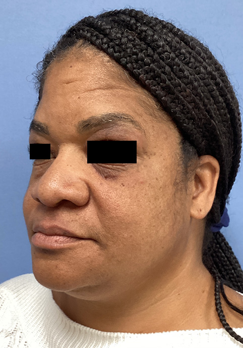 LIQUID RHINOPLASTY Before & After Gallery - Patient 427100 - Image 7