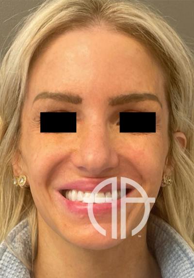 LIQUID RHINOPLASTY Before & After Gallery - Patient 122581 - Image 1