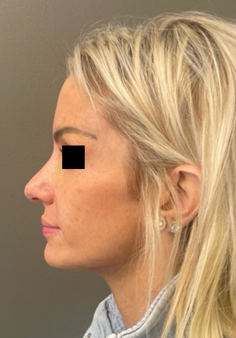 LIQUID RHINOPLASTY Before & After Gallery - Patient 122581 - Image 3