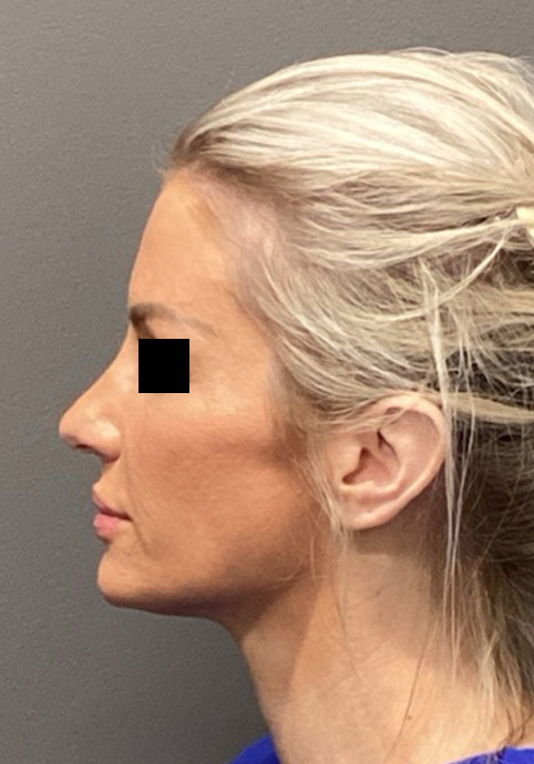 LIQUID RHINOPLASTY Before & After Gallery - Patient 122581 - Image 4
