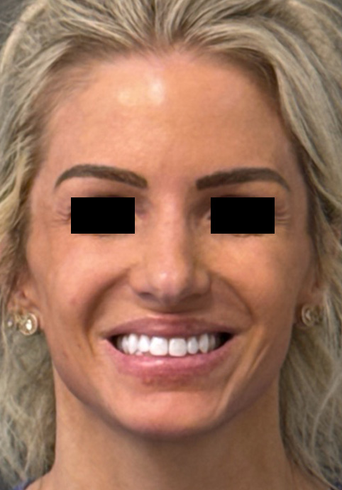 LIQUID RHINOPLASTY Before & After Gallery - Patient 122581 - Image 2