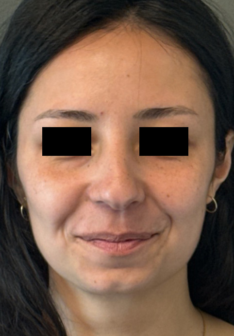 LIQUID RHINOPLASTY Before & After Gallery - Patient 388611 - Image 1
