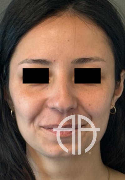 UNDEREYE FILLER Before & After Gallery - Patient 134241 - Image 1