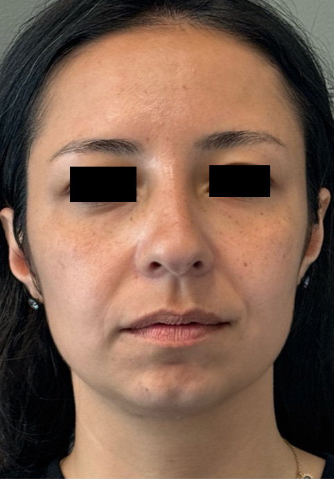 LIQUID RHINOPLASTY Before & After Gallery - Patient 388611 - Image 2