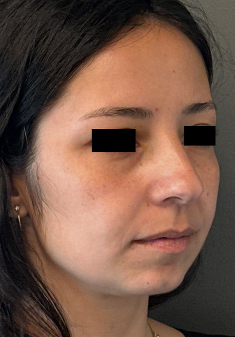 UNDEREYE FILLER Before & After Gallery - Patient 134241 - Image 3