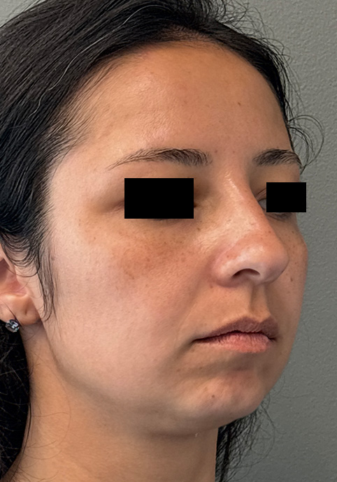 UNDEREYE FILLER Before & After Gallery - Patient 134241 - Image 4