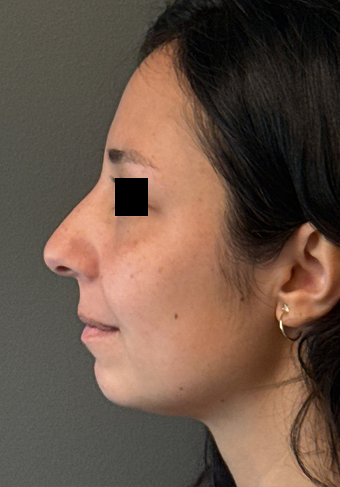 UNDEREYE FILLER Before & After Gallery - Patient 134241 - Image 5