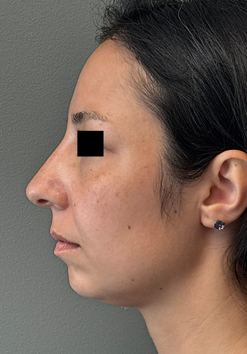 UNDEREYE FILLER Before & After Gallery - Patient 134241 - Image 6