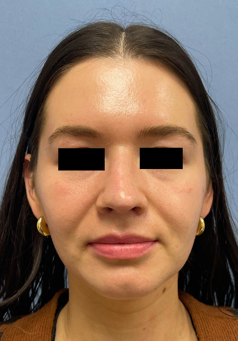 RHINOPLASTY Before & After Gallery - Patient 416568 - Image 2
