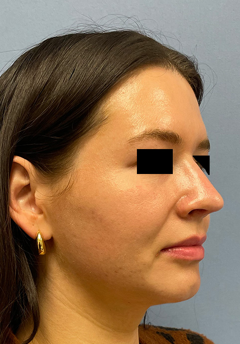 RHINOPLASTY Before & After Gallery - Patient 416568 - Image 4